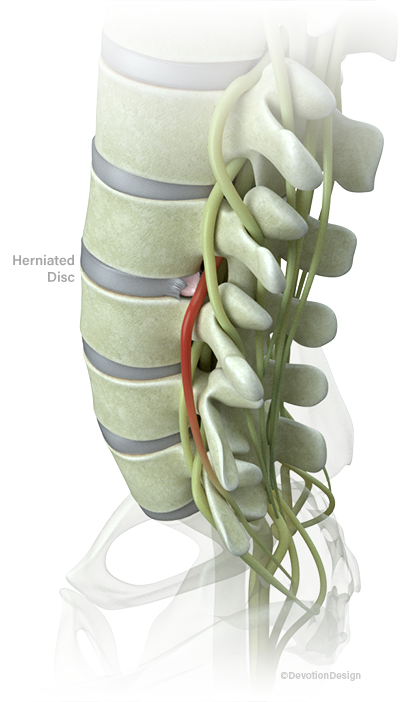 Herniated Disc Treatment