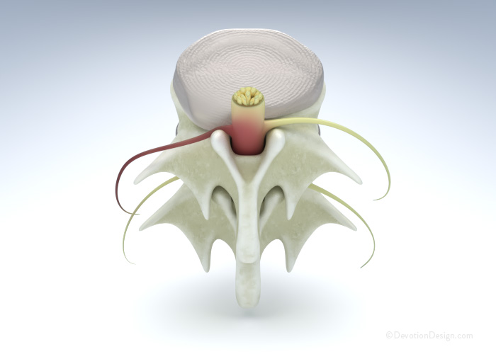 Degenerative Disc Disease