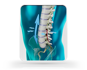 Herniated Disc Treatment